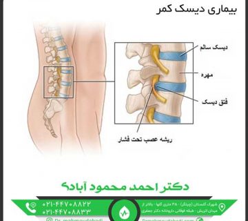 بیماری دیسک کمر کلینیک طب فیزیکی و توانبخشی دکتر احمد محمود آبادی